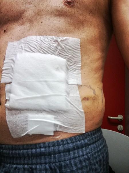 Bandage suite colostomie